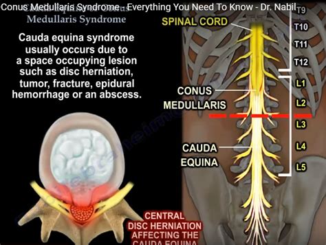 difference between conus medullaris and cauda equina|conus vs cauda equina syndrome.